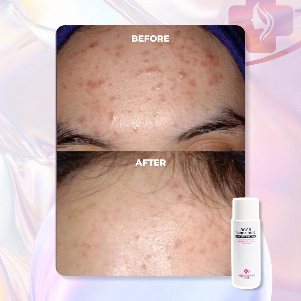 Acne Toner Mild - Gambar 4