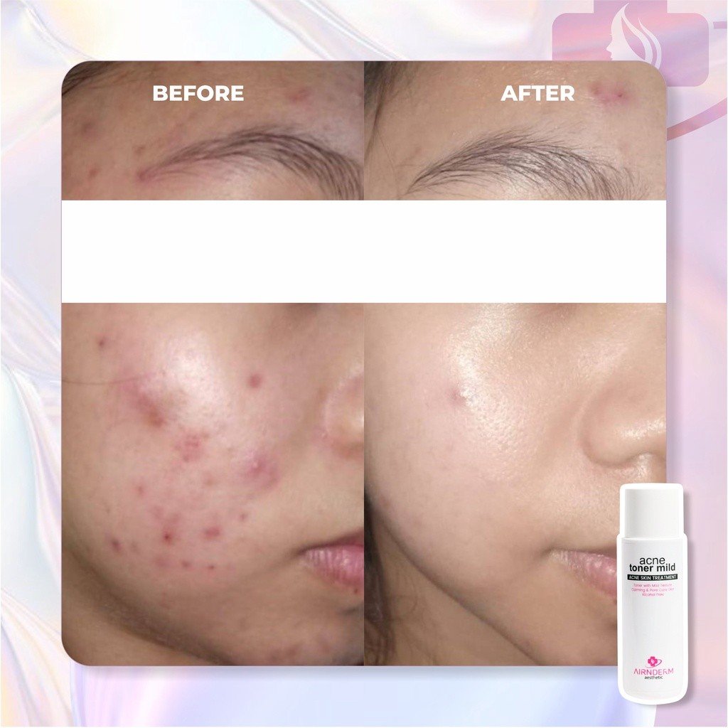 Acne Toner Mild - Gambar 5