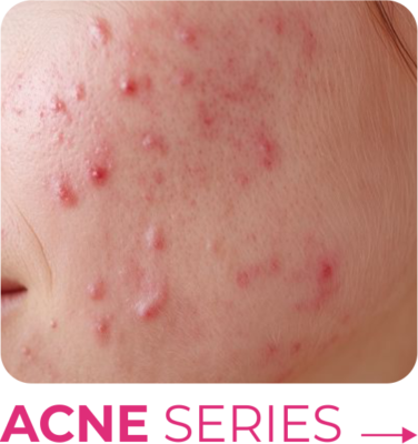 ⋆ ACNE SERIES ⋆