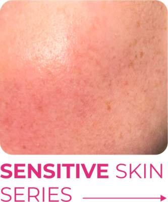 Sensitive Skin
