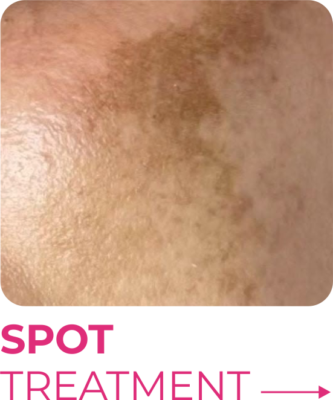 Spot Treatment